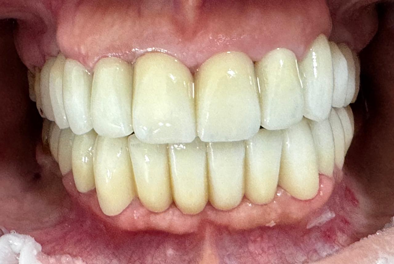 Après - Centre Dentaire Zeggar Casablanca